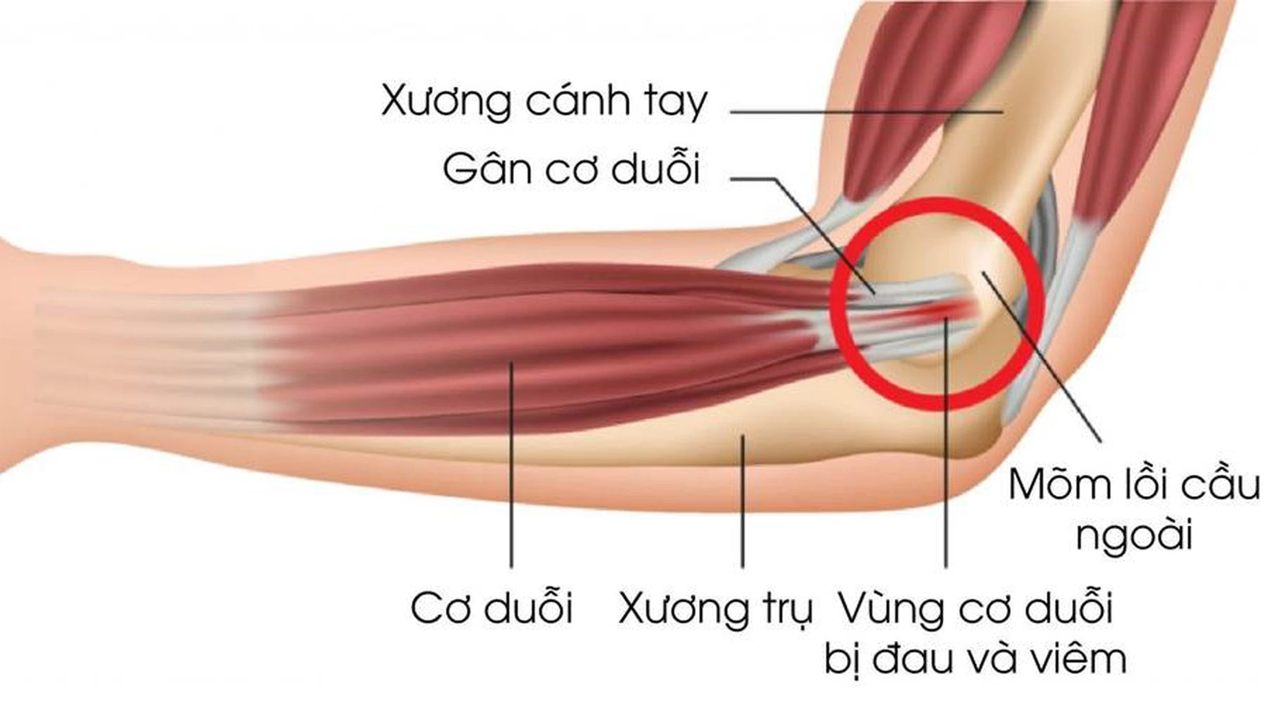 Chơi pickleball đau khuỷu tay: Nguyên nhân và cách xử lý 3 1 50c01a0cca