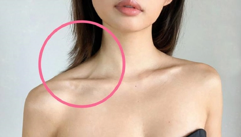 Xương quai xanh là gì? Thế nào là xương quai xanh đẹp? 11 Tổn thương vùng xương quai xanh bạn cần phải làm thế nào?