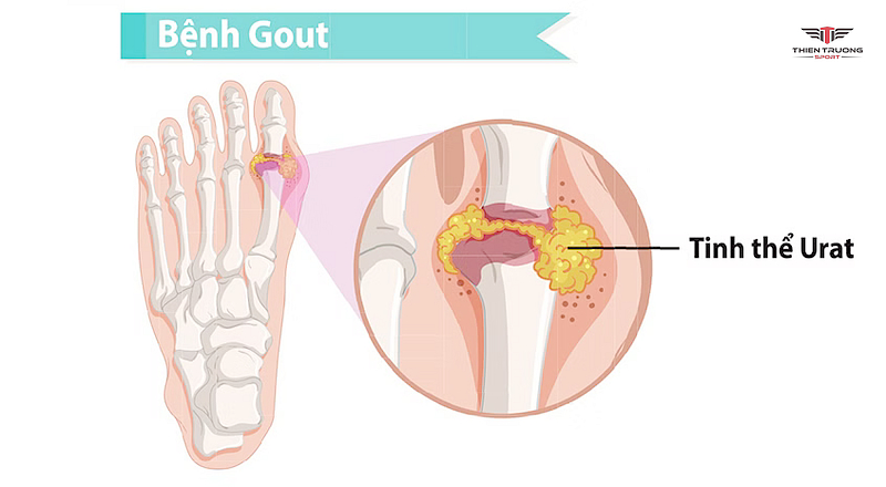 Bệnh gout là gì? Nguyên nhân dẫn tới bệnh gout 3 acid uric nguyên nhân trực tiếp gây bệnh gout