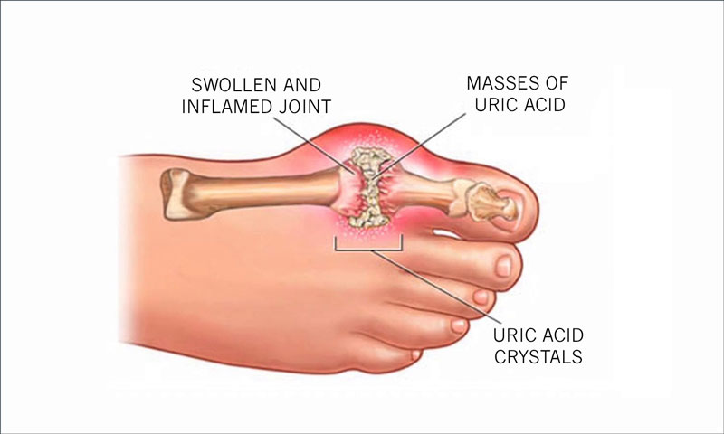 Bệnh gout là gì? Nguyên nhân dẫn tới bệnh gout 2 viêm khớp ở bệnh gout