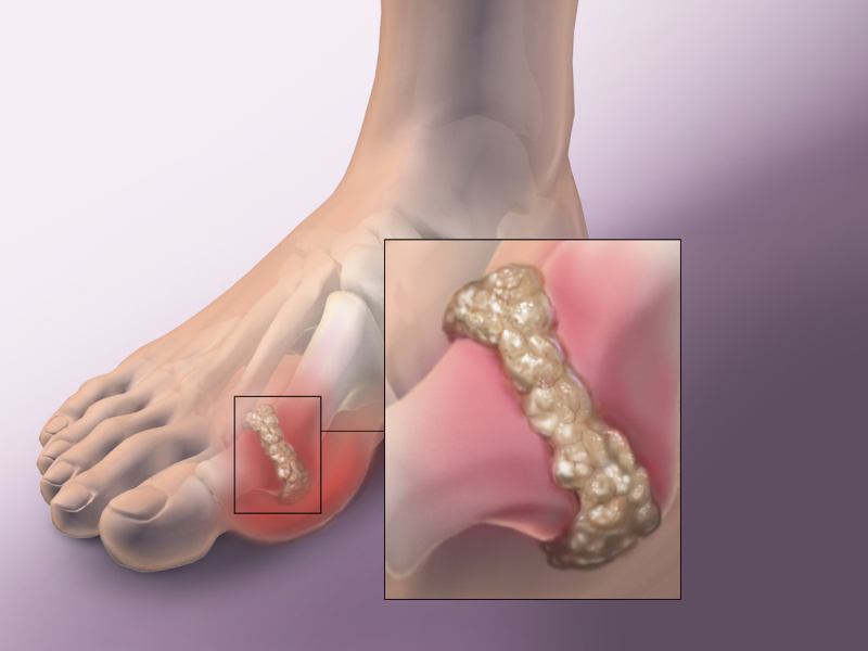 người bị gout